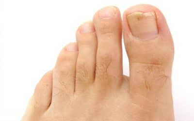 Treating & Preventing Ingrown Toenails