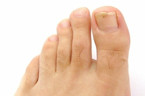 Treating & Preventing Ingrown Toenails