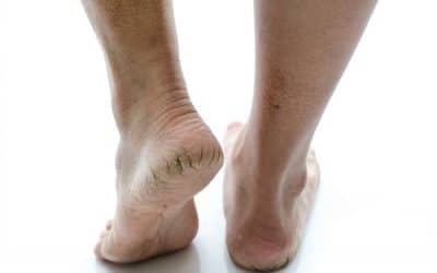 Quick Tips for Dry Cracked Heels