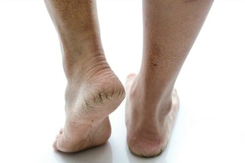 Dry Skin & Cracked Heels - Waverley Foot Clinic